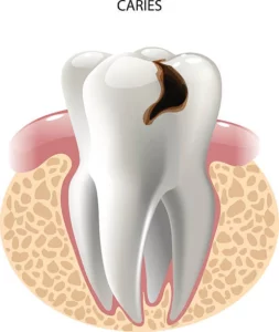 receding gum exposing nerve