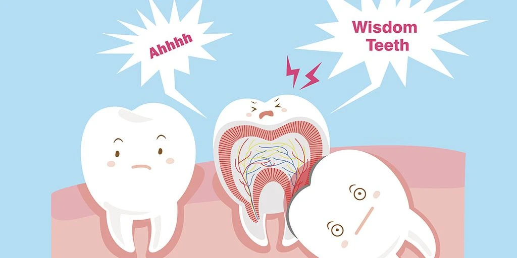 what are impacted wisdom teeth