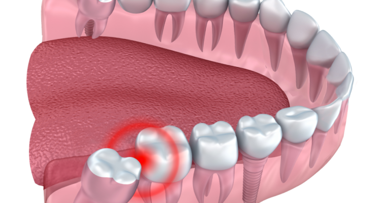 impacted teeth