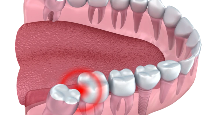 wisdom teeth
