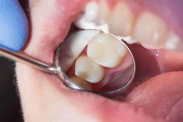what to expect after getting a composite filling