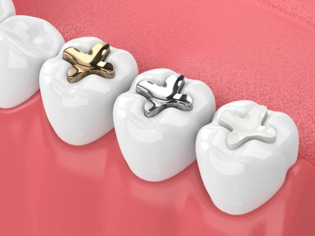 composite fillings
