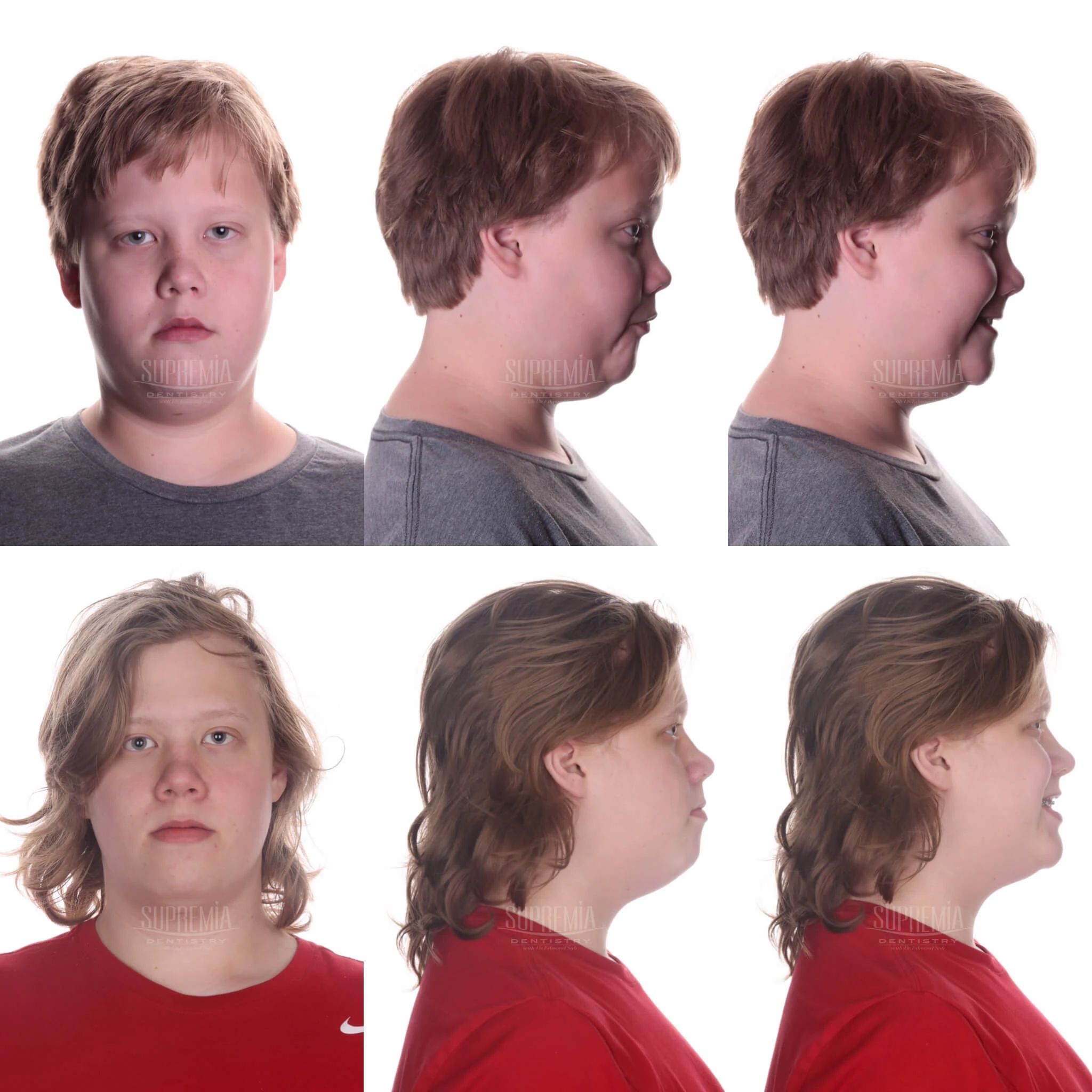 jaw and facial development in children