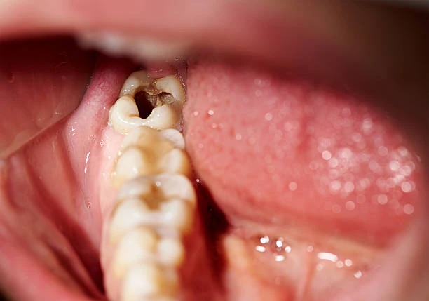 how long does it take for a cavity to form