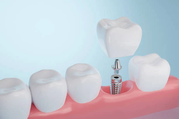 benefits of dental implants