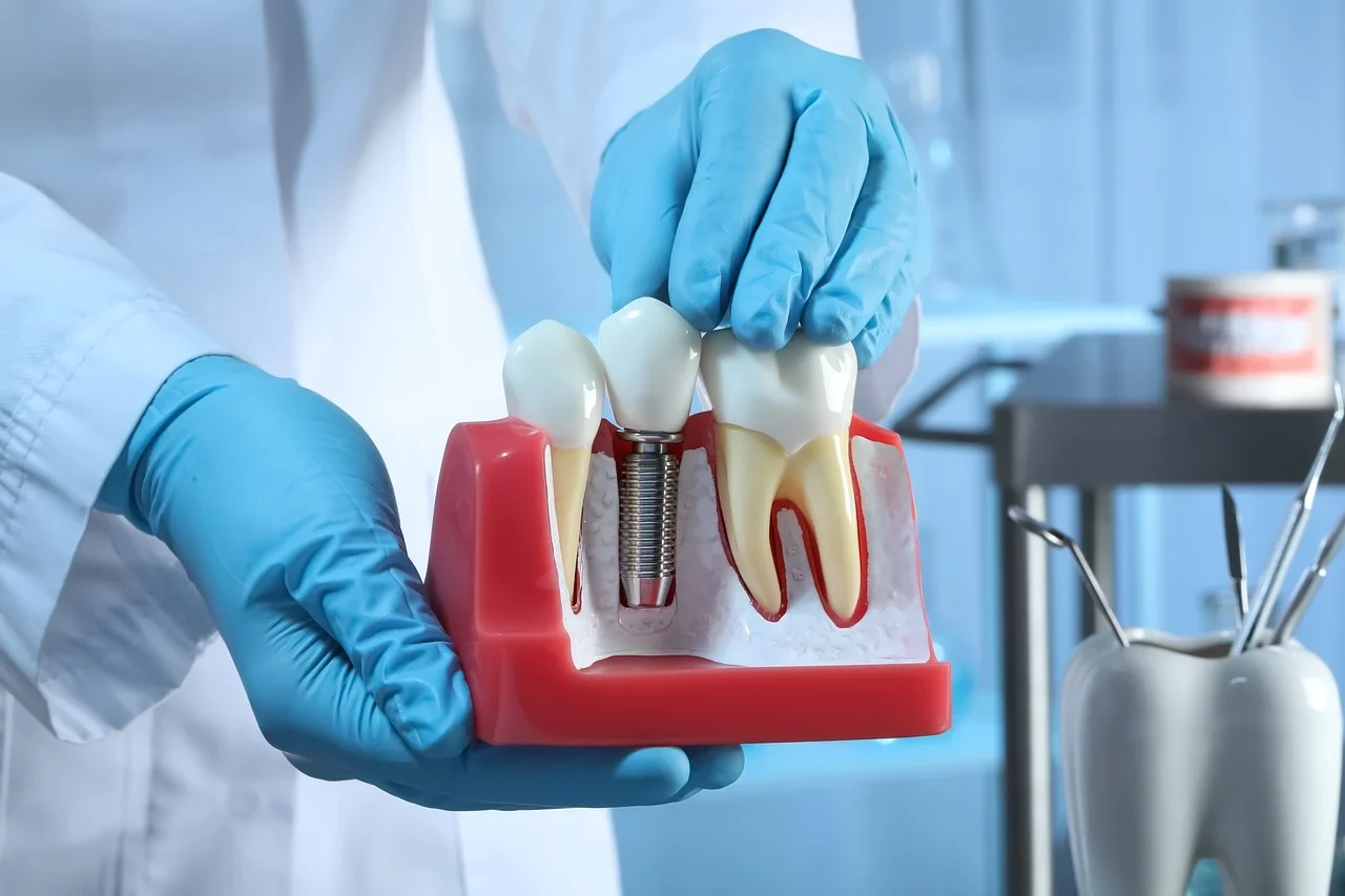 who does dental implants