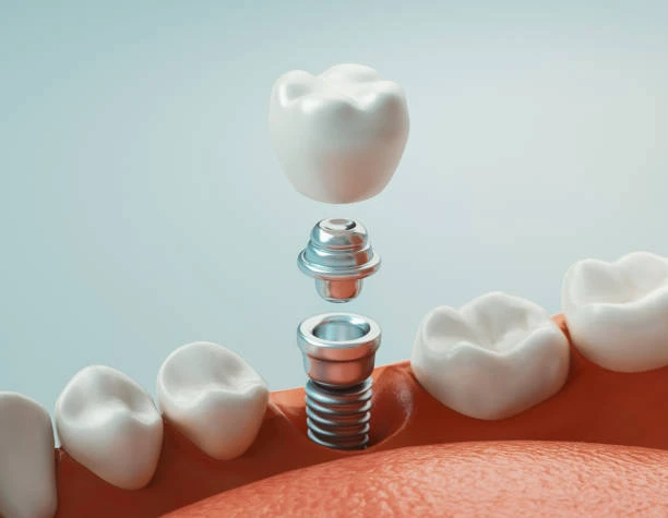 what do dental implants look like