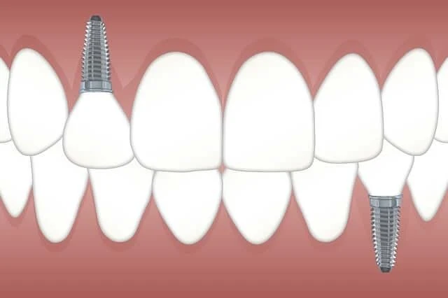 dental implant process varies depending on individual factors