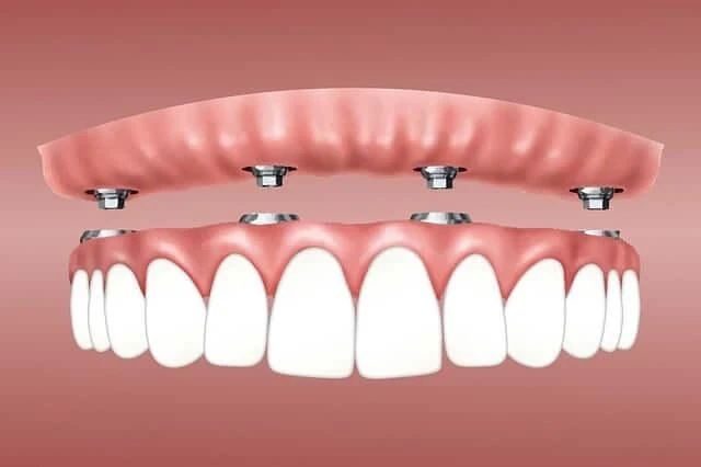 what are all on 4 dental implants