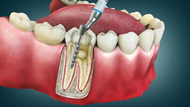 root canal treatment for front teeth