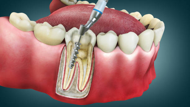 an image showing how the part of the tooth with cavity is cleaned