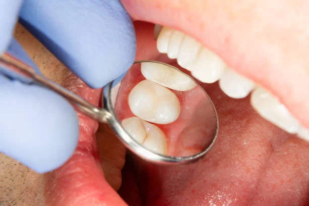root canals are a valuable tool in preserving your natural teeth