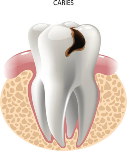 a digital illustration of a tooth with decay