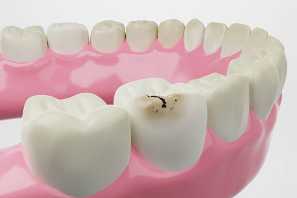 a tooth with cavities
