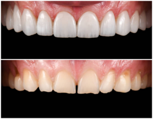 before and after of veneer procedure