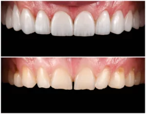 veneers20as20a20cosmetic20solution