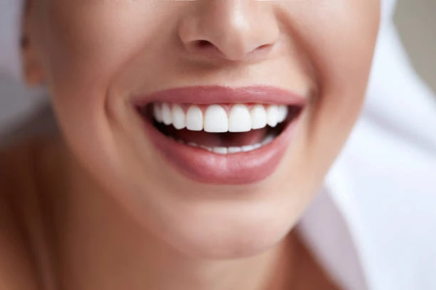 set of veneers