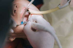 close-up shot of a mouth during root canal treatment