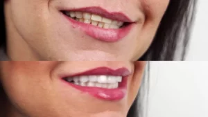 benefits and drawbacks of veneers