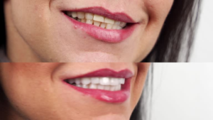comparison of before and after veneers