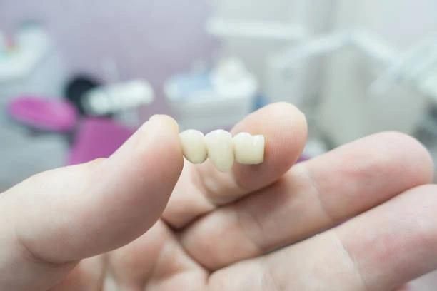 dental bridges
