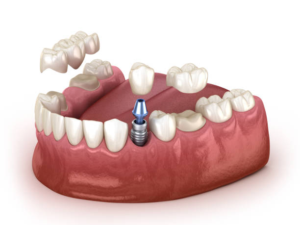 Dental bridge, crown, and implant