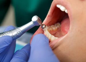 professional dental brushing