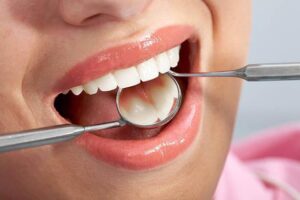 image showing the back of a person's teeth