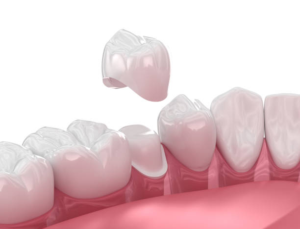 a graphic illustration showing a dental crown