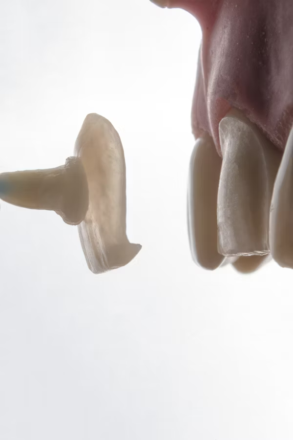 photo showing how veneers are attached to the teeth