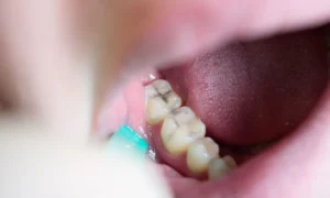 tooth cavity visible in molar dental mirror Wake Forest NC