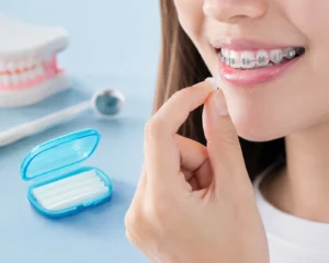 Patient applying orthodontic wax to braces to reduce irritation and improve comfort during orthodontic treatment
