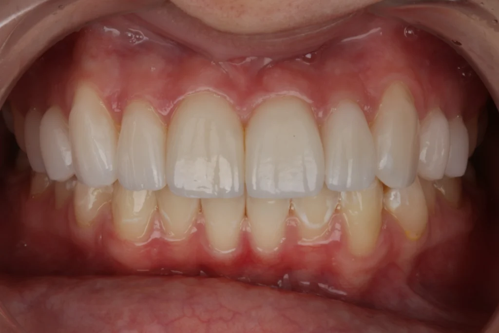 after with no prep veneers