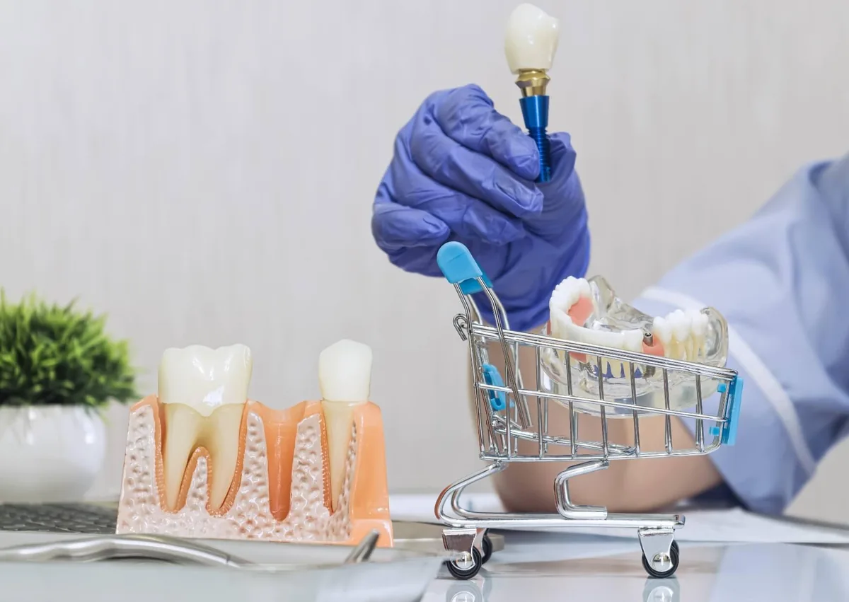 Dental implant model illustrating affordable dental implants and tooth replacement options.